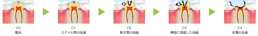 痛みを感じたら症状は進行しています～虫歯治療～