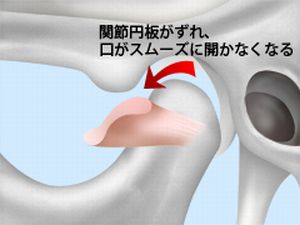 顎関節症の治療について