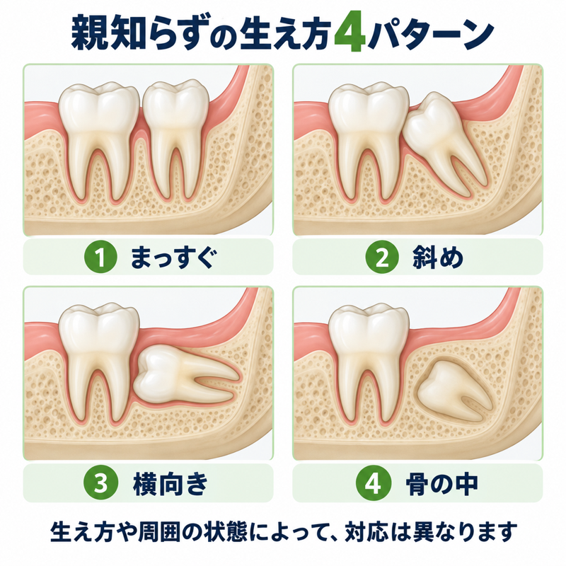 加古川で親知らずを抜くとき ── 抜く前に知っておきたいこと